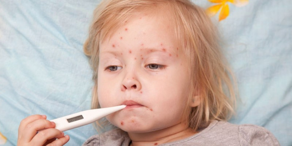 Measles Outbreak: बच्चों में खसरा के मामले अचानक क्यों बढ़ रहे हैं? जानें क्या कहना है डॉक्ट्स का
