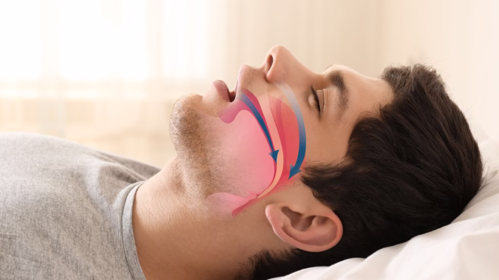 सर्दियों में खर्राटे: नींद से लेकर दिल और मस्तिष्क तक का खतरा ,KGMU में रोज 100 मरीज अस्पताल पहुंच रहे 3 sleep apnea snoring 0f2dde5202c326b97699468487495158